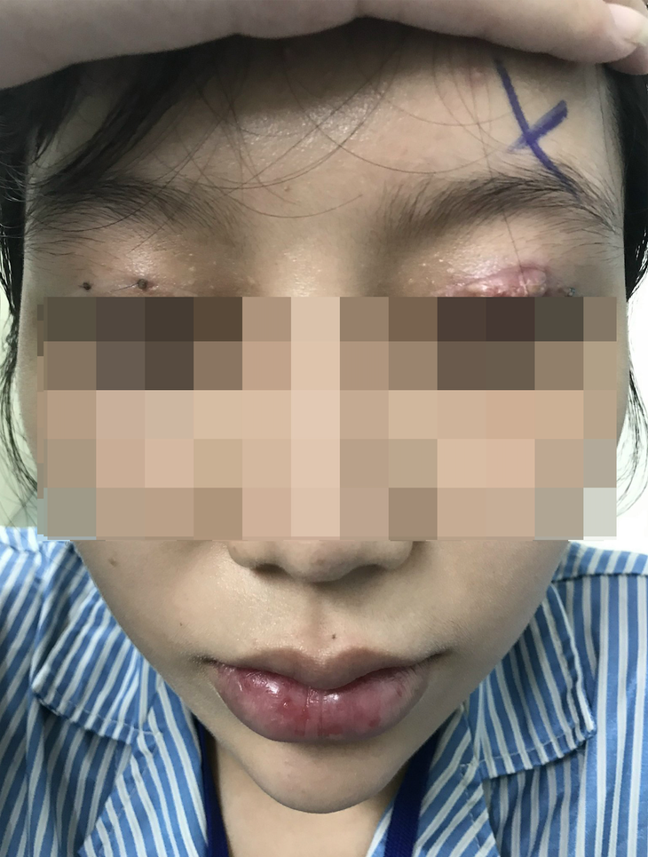 Cắt mí mắt ở cơ sở thẩm mỹ "chui", một phụ nữ bị hỏng mắt - Ảnh 1.