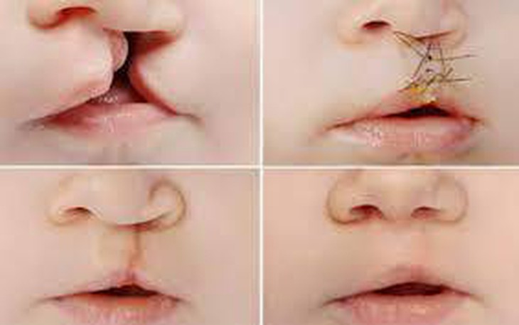 Những vấn đề thường gặp khi chăm sóc trẻ dị tật khe hở môi - vòm miệng