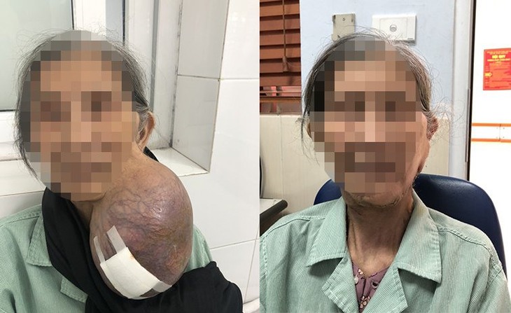 Khối u 'dính' hơn 40 năm ở cổ khiến cụ bà không khép miệng được, khi nói không thể ngẩng đầu - Ảnh 1. Khối u 'dính' hơn 40 năm ở cổ khiến cụ bà không khép miệng được, khi nói không thể ngẩng đầu - Ảnh 1.