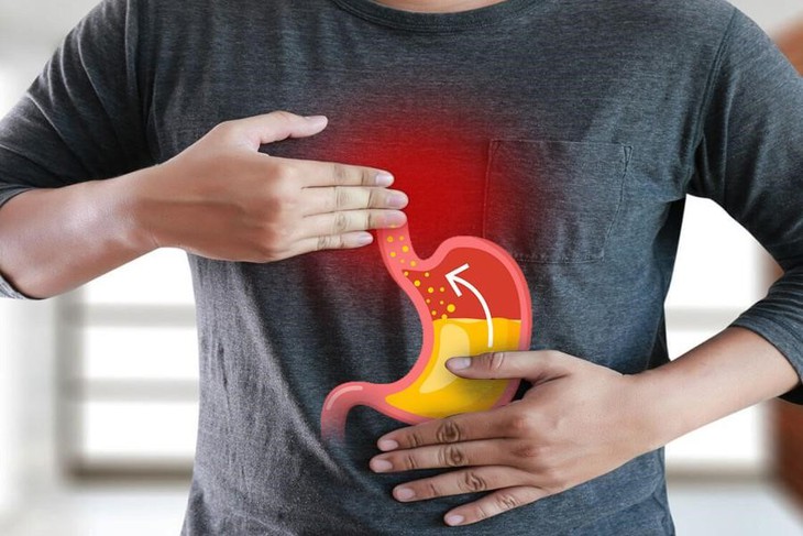 Trào ngược dạ dày thực quản, triệu chứng, nguyên nhân và cách điều trị - Ảnh 1.