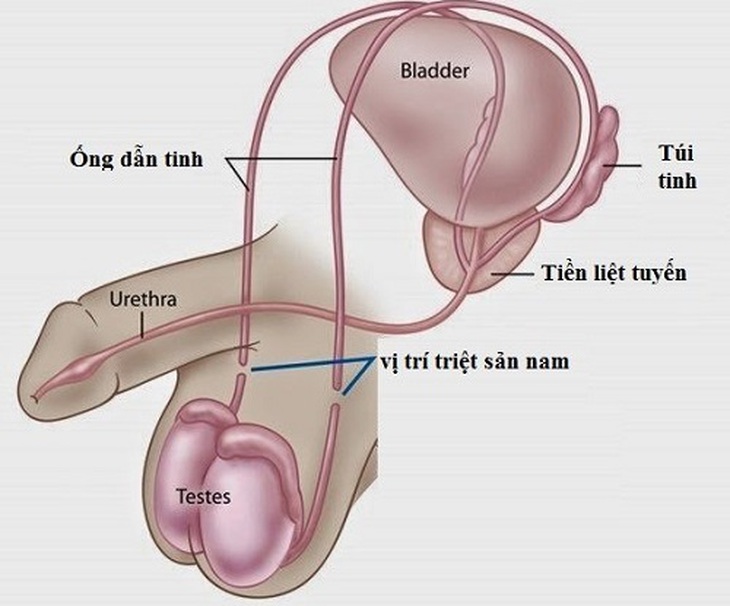 Những điều nên biết về đảo ngược ống dẫn tinh - Ảnh 2.