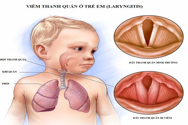 Bệnh viêm thanh khí phế quản cấp tính thường kéo dài trong khoảng vài ngày rồi khỏi hẳn trong 7 ngày nếu được điều trị đúng cách.