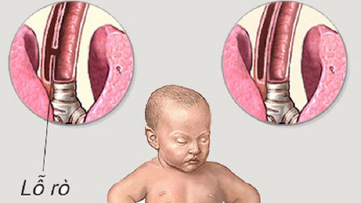 Teo thực quản bẩm sinh có điều trị được không? - Ảnh 2.