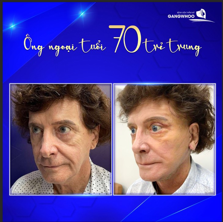 Ưu điểm của căng da mặt công nghệ căng chỉ Face Lifting Thermage - Ảnh 1.