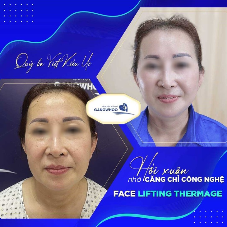Ưu điểm của căng da mặt công nghệ căng chỉ Face Lifting Thermage - Ảnh 2.