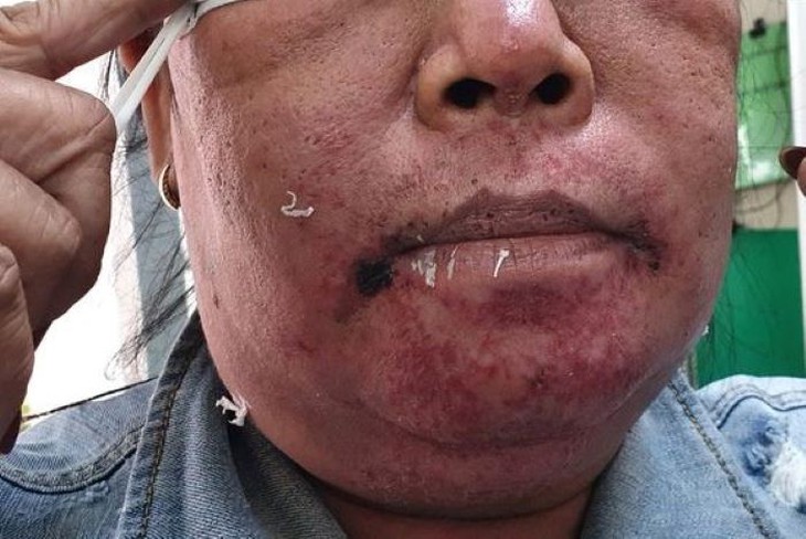 Dùng thuốc 7 màu chữa dị ứng do kem trộn khiến da nứt nẻ chảy dịch. - Ảnh 1.