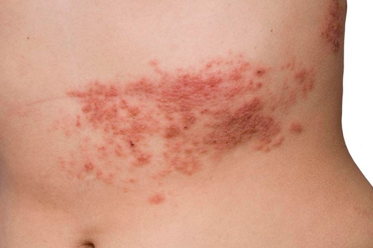 Vị trí phát ban của bệnh đậu mùa khỉ và zona có khác nhau? - Ảnh 4.