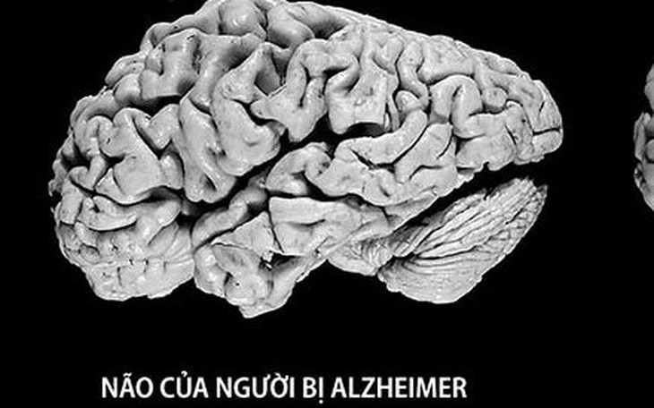 Thuốc mới điều trị bệnh Alzheimer