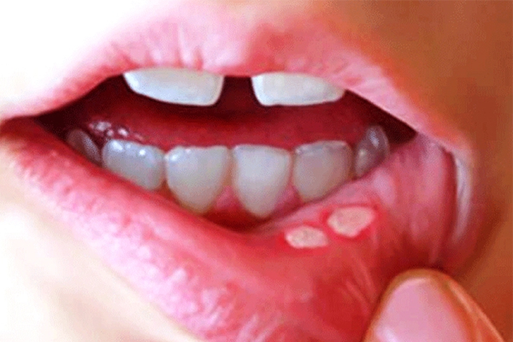 Cách chăm sóc đúng khi trẻ bị nhiệt miệng - Ảnh 2.