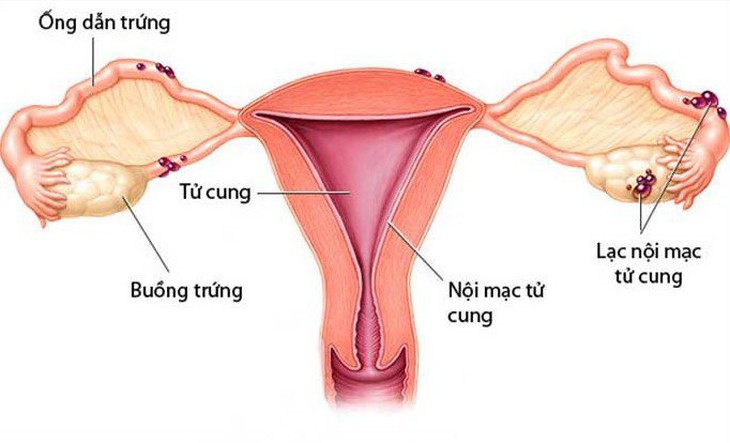 Lạc nội mạc tử cung có gây vô sinh? - Ảnh 2.