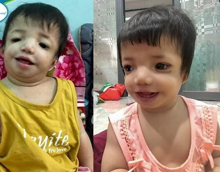 Người mẹ trẻ hạnh phúc nghẹn ngào vì gương mặt con gái 10 tháng mắc dị tật hiếm gặp dần trở lại bình thường - Ảnh 1. Người mẹ trẻ hạnh phúc nghẹn ngào vì gương mặt con gái 10 tháng mắc dị tật hiếm gặp dần trở lại bình thường - Ảnh 1.