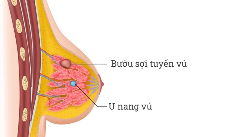 Có khối u ở vú, khi nào nghi ngờ là ung thư? - Ảnh 3.