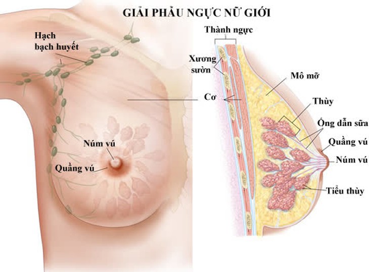 Có khối u ở vú, khi nào nghi ngờ là ung thư? - Ảnh 1.