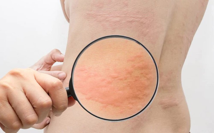 9 giải pháp giảm ngứa do mề đay lúc chuyển mùa