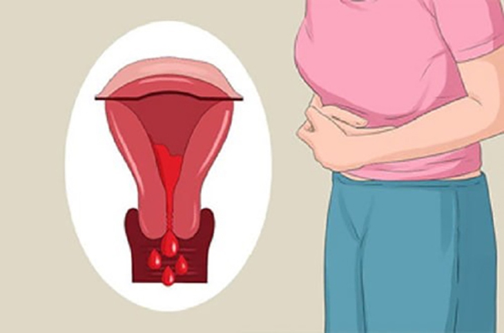 Làm gì khi có dấu hiệu rong kinh? - Ảnh 2.