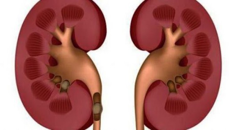 Viêm ống kẽ thận cấp: Nguyên nhân và các biểu hiện cần biết - Ảnh 1.