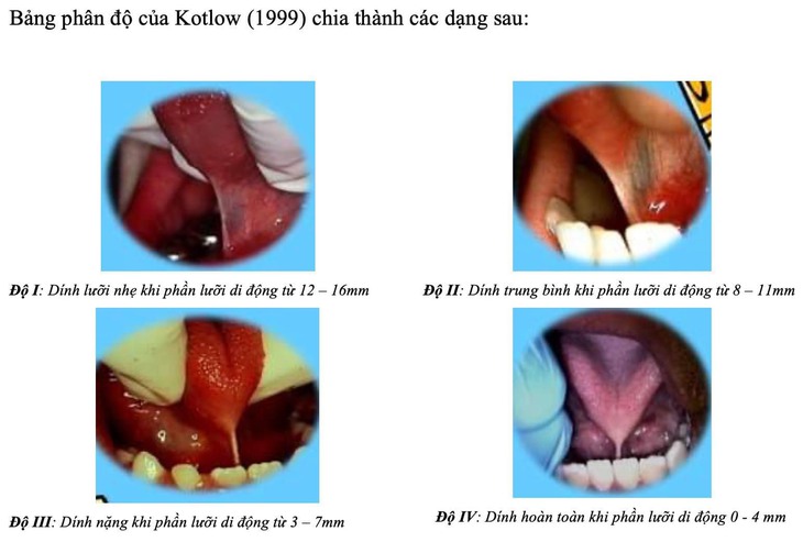 Phát hiện trẻ dính thắng lưỡi và những biện pháp can thiệp - Ảnh 3.