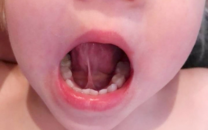 Phát hiện trẻ dính thắng lưỡi và những biện pháp can thiệp