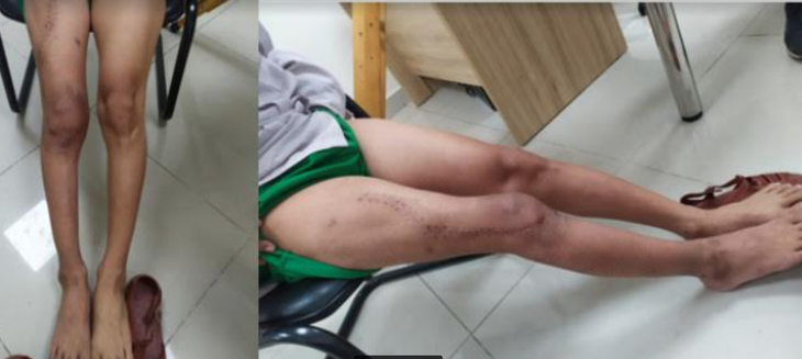 Ngâm xương trong Ni-tơ lạnh, cứu đôi chân chiến sĩ trẻ bị ung thư - Ảnh 2.