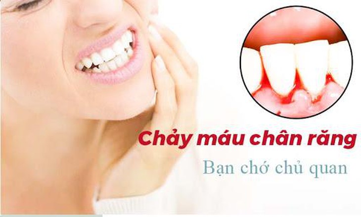 Viêm lợi, chảy máu chân răng… có thể mất răng bởi viêm quanh răng mạn tính - Ảnh 1.