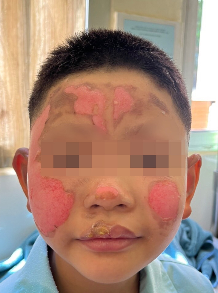 Bật lửa phát nổ, bé trai 8 tuổi bỏng vùng mặt - Ảnh 1.
