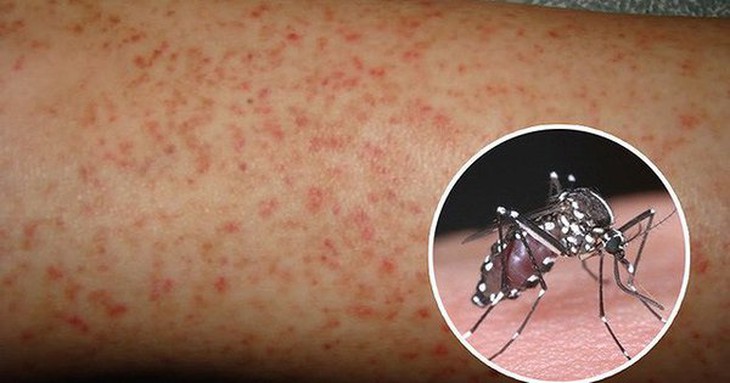 Bệnh sốt xuất huyết xuất hiện thêm chủng mới, bác sĩ khuyến cáo điều gì?