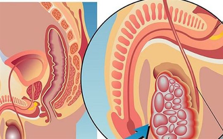 Các bước tự khám ung thư tinh hoàn - nỗi lo của nam giới trẻ tuổi