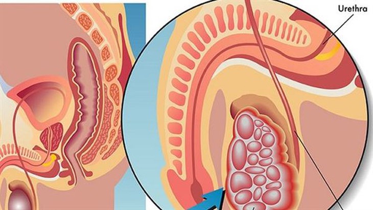 Các bước tự khám ung thư tinh hoàn và nỗi lo của nam giới trẻ tuổi - Ảnh 1.