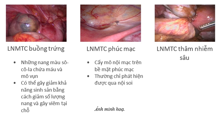Phụ nữ đừng im lặng chịu đựng cơn đau lạc nội mạc tử cung - Ảnh 3.