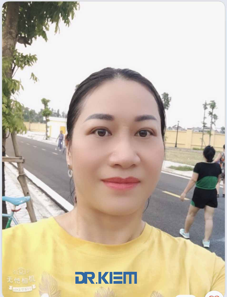 Cá thể hóa cắt mí mắt - Ảnh 1.