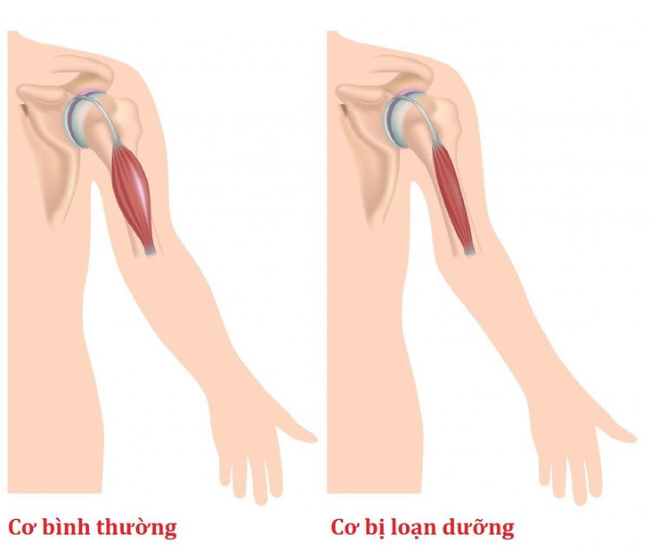 Trẻ thường yếu, chậm biết đi, hay ngã… thận trọng với loạn dưỡng cơ tiến triển - Ảnh 2.