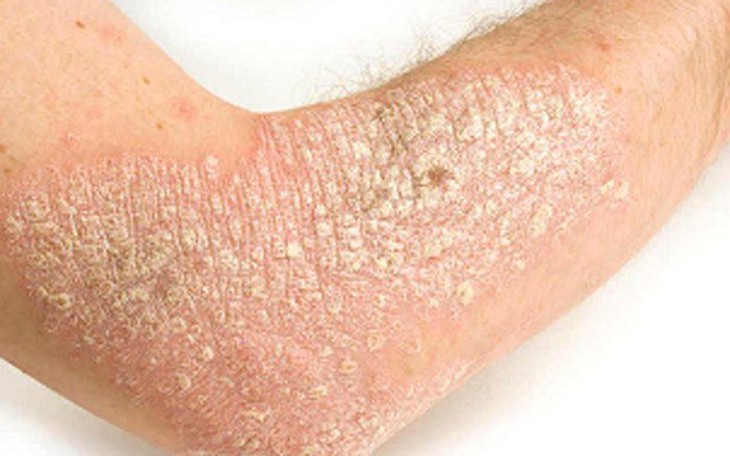 Các thuốc trị bệnh vẩy nến