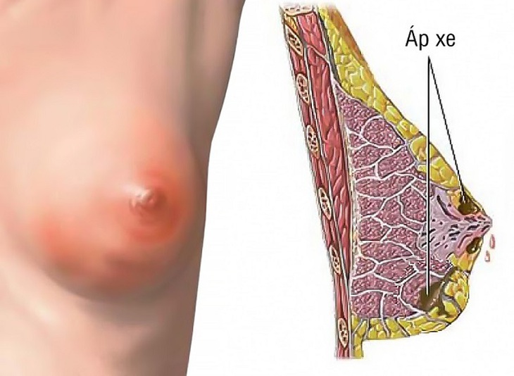 Những yếu tố làm tăng nguy cơ mắc áp xe vú và cách xử trí - Ảnh 1.