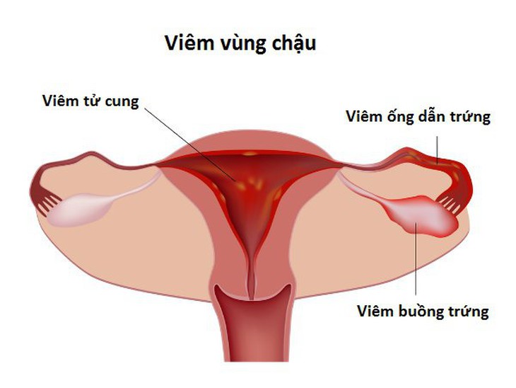 Đau vùng chậu ở phụ nữ là dấu hiệu bệnh gì? - Ảnh 4.