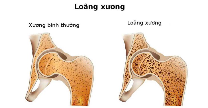 Loãng xương: 8 nhóm yếu tố nguy cơ bạn cần biết - Ảnh 1. Loãng xương: 8 nhóm yếu tố nguy cơ bạn cần biết - Ảnh 1.