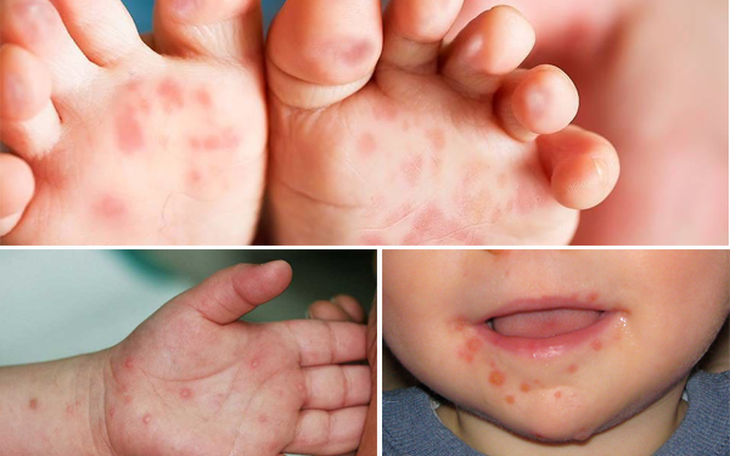 Đắk Lắk: Số ca bệnh tay chân miệng tăng cao