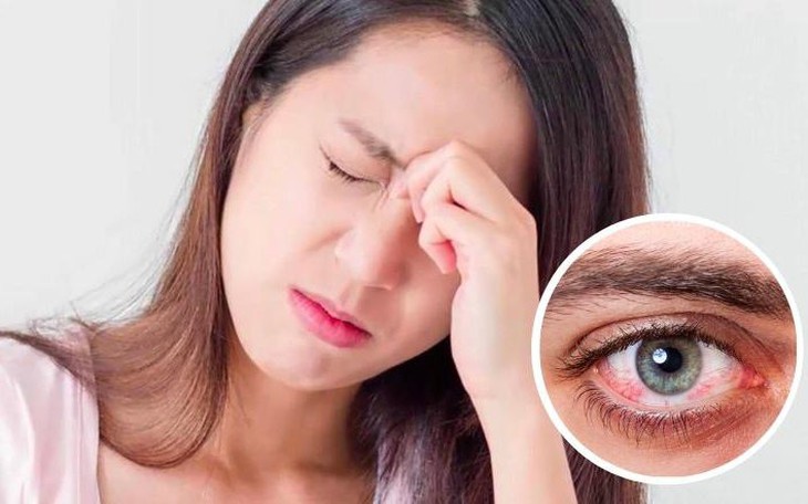 Mùa mưa bão, chủ động phòng bệnh đau mắt đỏ