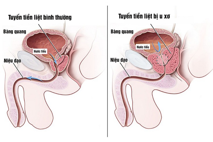U xơ tuyến tiền liệt có ảnh hưởng đến đời sống tình dục ở nam giới? - Ảnh 2. U xơ tuyến tiền liệt có ảnh hưởng đến đời sống tình dục ở nam giới? - Ảnh 2.