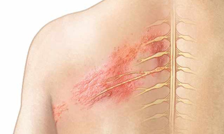 Tổn thương do zona thần kinh làm thế nào phân biệt? - Ảnh 1.