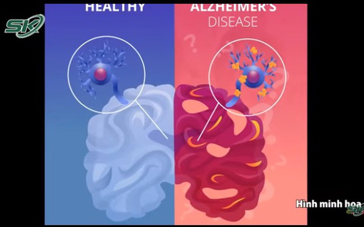 Cảnh báo: Bệnh Alzheimer trẻ hóa, nhiều người 30 tuổi đã lúc nhớ lúc quên