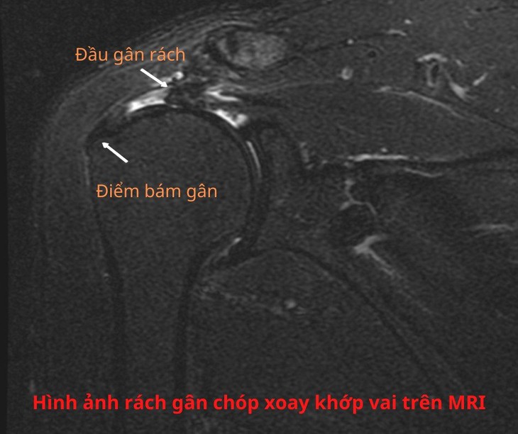 Nội soi khâu gân cơ chóp xoay khớp vai giúp người bệnh hết đau, hồi phục nhanh - Ảnh 3. Nội soi khâu gân cơ chóp xoay khớp vai giúp người bệnh hết đau, hồi phục nhanh - Ảnh 3.