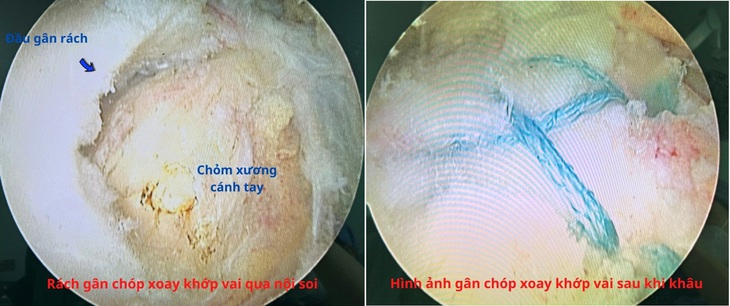 Nội soi khâu gân cơ chóp xoay khớp vai giúp người bệnh hết đau, hồi phục nhanh - Ảnh 4. Nội soi khâu gân cơ chóp xoay khớp vai giúp người bệnh hết đau, hồi phục nhanh - Ảnh 4.