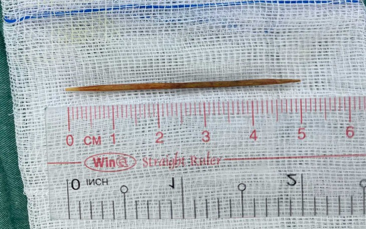 Nuốt phải tăm xỉa răng, bé 8 tuổi thủng tá tràng