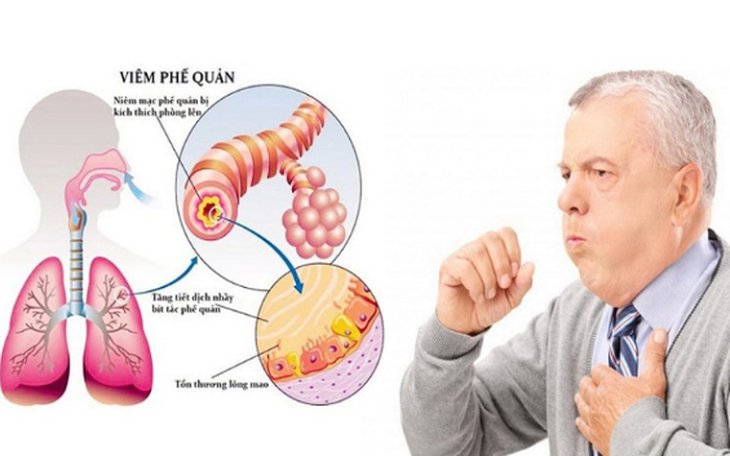 Cảnh giác với biến chứng viêm phế quản và cách phòng tránh