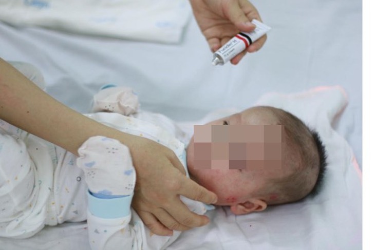 Chuyên gia hướng dẫn cha mẹ cách chăm sóc và lựa chọn thực phẩm khi trẻ bị chàm sữa - Ảnh 3. Chuyên gia hướng dẫn cha mẹ cách chăm sóc và lựa chọn thực phẩm khi trẻ bị chàm sữa - Ảnh 3.