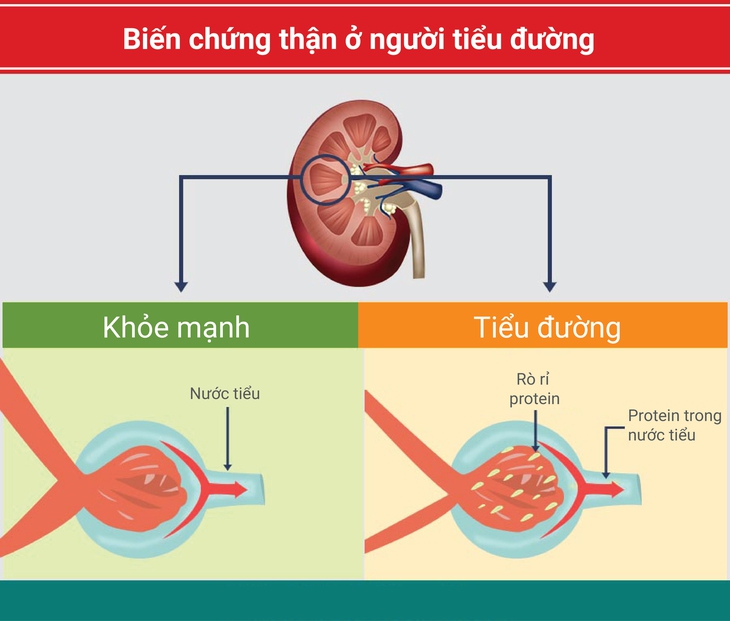 Tổn thương thận do đái tháo đường khi nào đáng lo? - Ảnh 1.