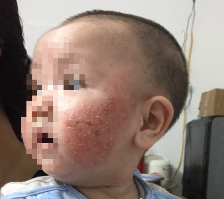 Chuyên gia hướng dẫn cha mẹ cách chăm sóc và lựa chọn thực phẩm khi trẻ bị chàm sữa - Ảnh 2. Chuyên gia hướng dẫn cha mẹ cách chăm sóc và lựa chọn thực phẩm khi trẻ bị chàm sữa - Ảnh 2.