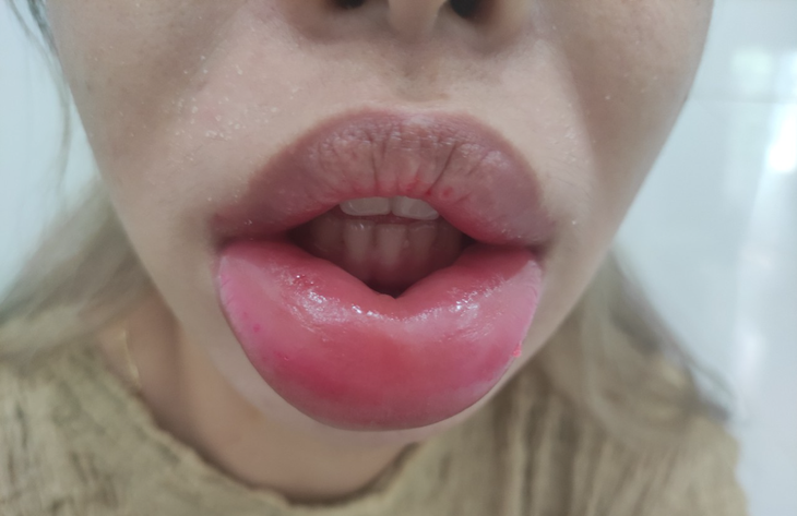 Môi sưng phồng, bầm tím, đau nhức sau khi tiêm filler - Ảnh 1.