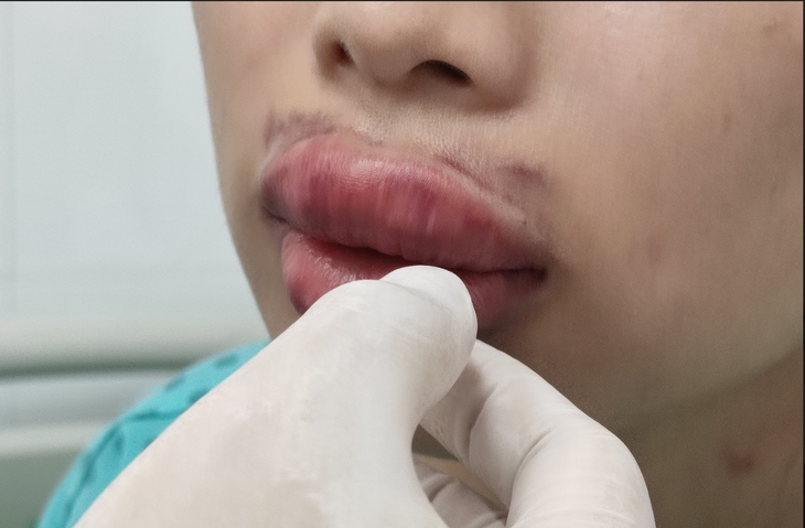 Môi sưng phồng, bầm tím, đau nhức sau khi tiêm filler - Ảnh 2.