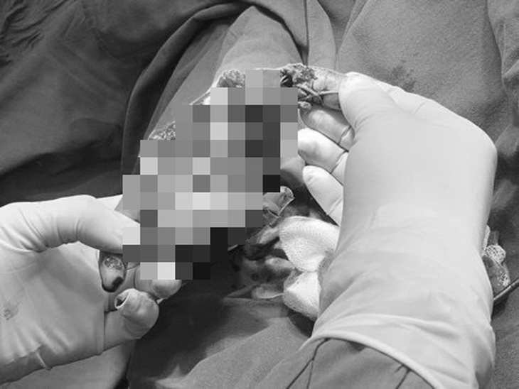 Hải Phòng: Nhiều trẻ nhập viện nát cả bàn tay vì tai nạn pháo nổ - Ảnh 2.